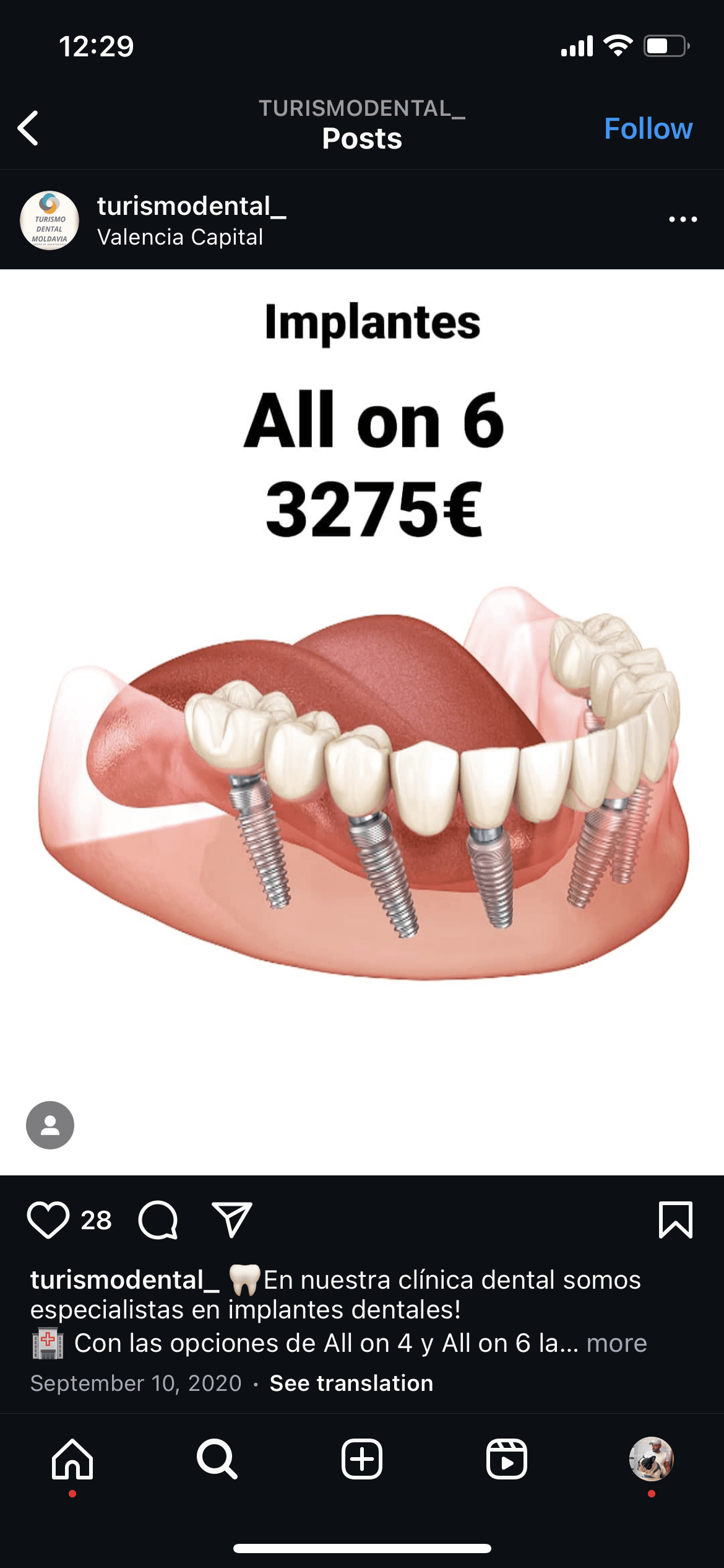 Porcelain veneers
